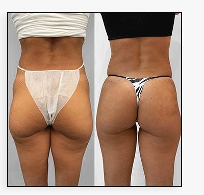 BootyFix: Sculptra Butt Lift