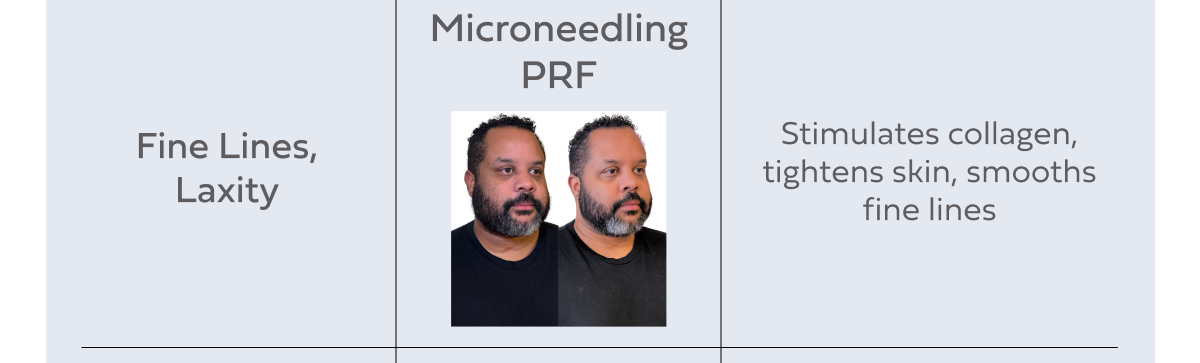 MICRONEEDLING PRF