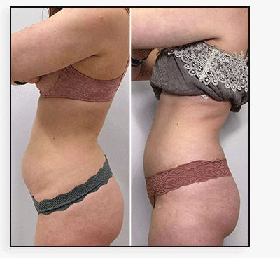 BodyFix: CoolSculpting® Elite