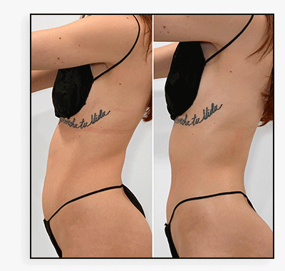 BodyFix: CoolSculpting® Elite