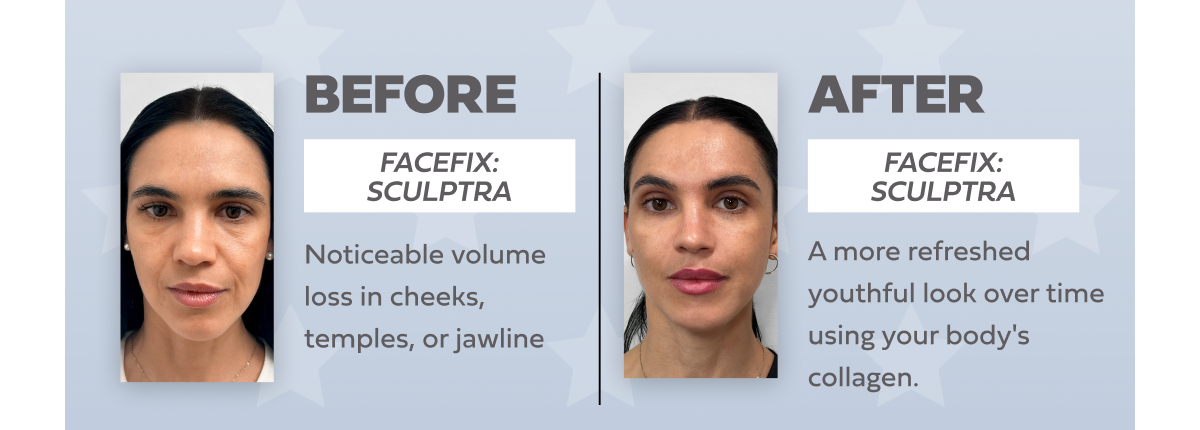 FACEFIX SCULPTRA