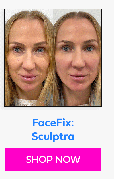 FaceFix: Sculptra
