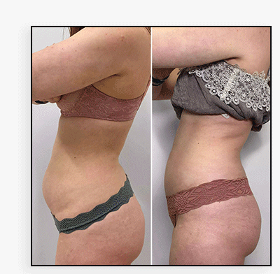 BodyFix: CoolSculpting® Elite