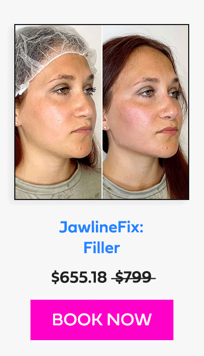 JawlineFix: Filler