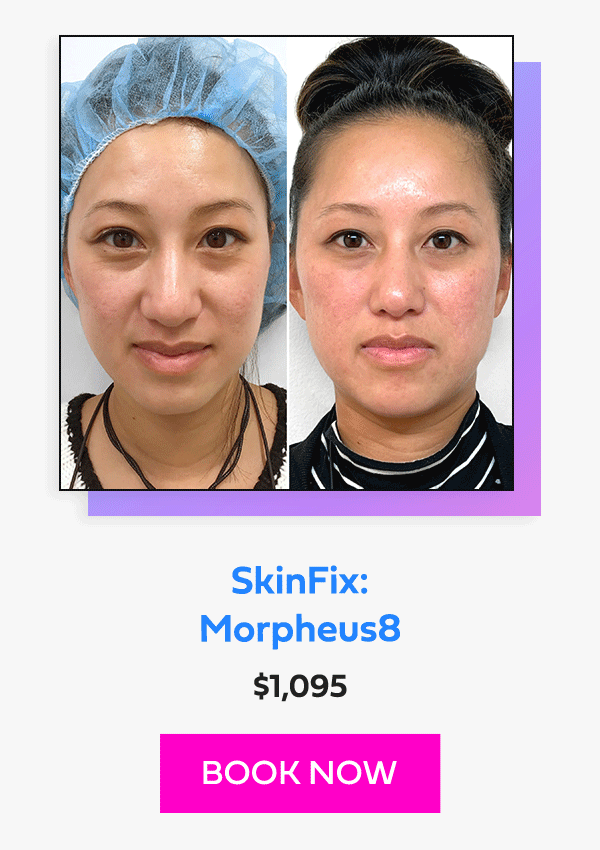 SkinFix: Morpheus8