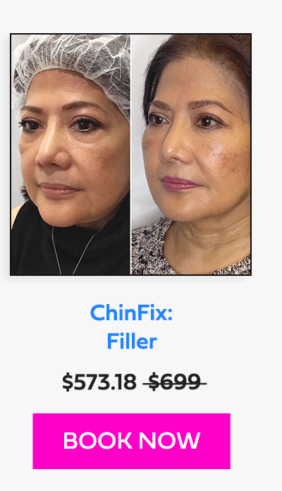 ChinFix: Filler