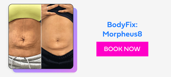 BodyFix: Morpheus8