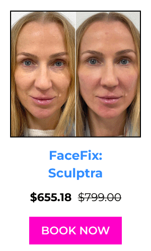 FaceFix: Sculptra