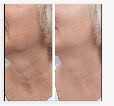 NeckFix: Platysmal Bands