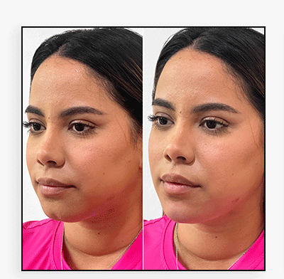 ChinFix: truSculpt iD