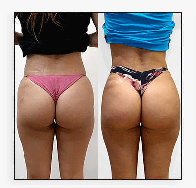 BootyFix: Radiesse Butt Lift