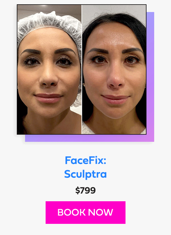 FaceFix: Sculptra