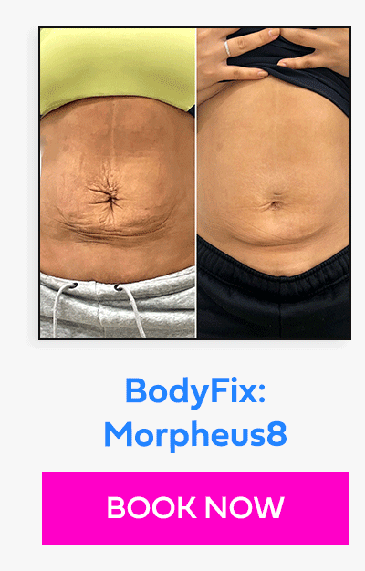 BodyFix: Morpheus8