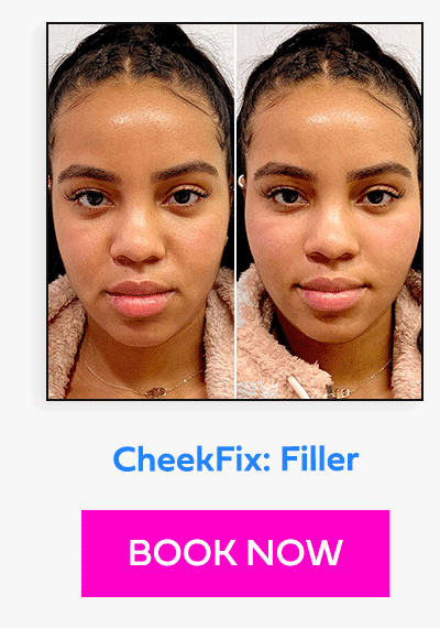 CheekFix: Filler
