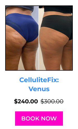 CelluliteFix: Venus