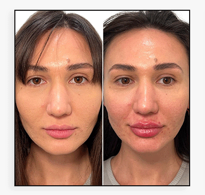 LipFix: Filler