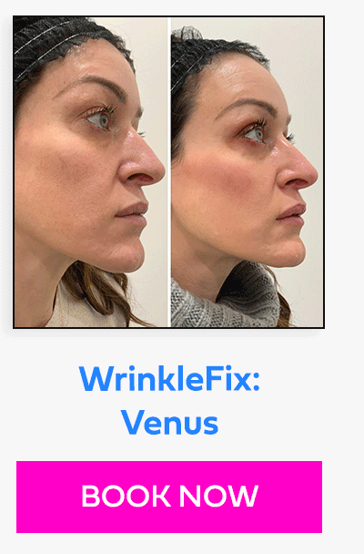 WrinkleFix: Venus