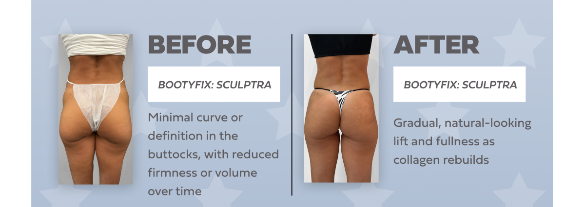 BOOTYFIX SCULPTRA