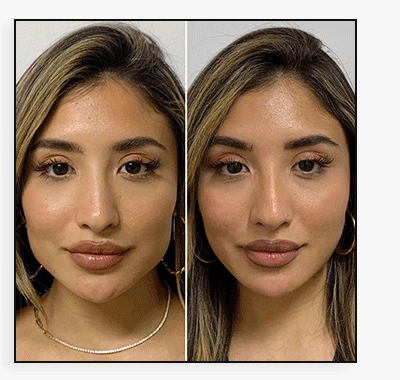 JawlineFix: Masseter Botox