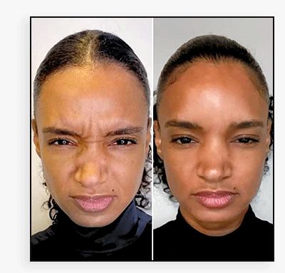 WrinkleFix: Botox (Existing Customers)