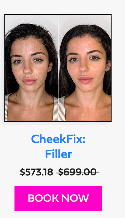 CheekFix: Filler