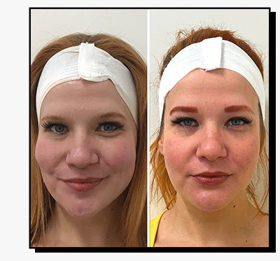 SkinFix: DSE Peel + Microneedling