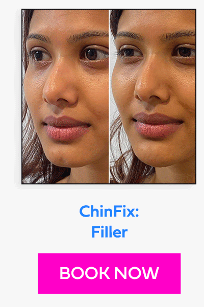 ChinFix: Filler