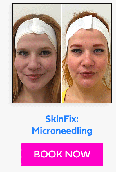 SkinFix: Microneedling