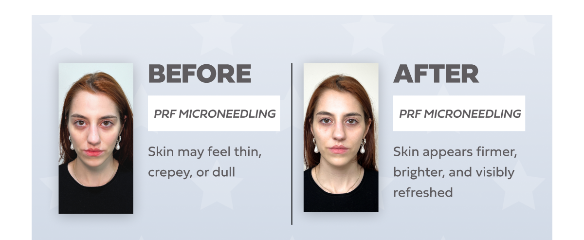 PRF MICRONEEDLING