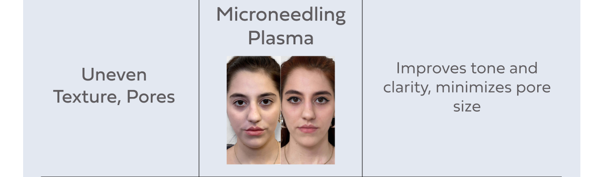 MICRONEEDLING PLASMA