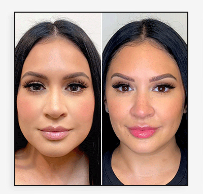 JawlineFix: Masseter Botox