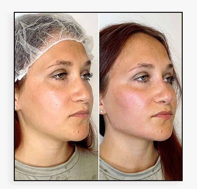 JawlineFix: Filler