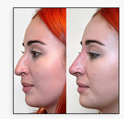 NoseFix: Botox