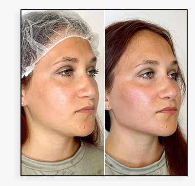 JawlineFix: Filler