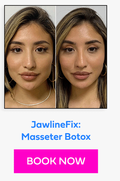 JawlineFix: Masseter Botox