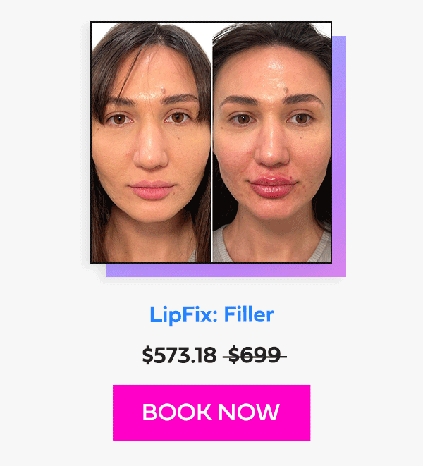 LipFix: Filler
