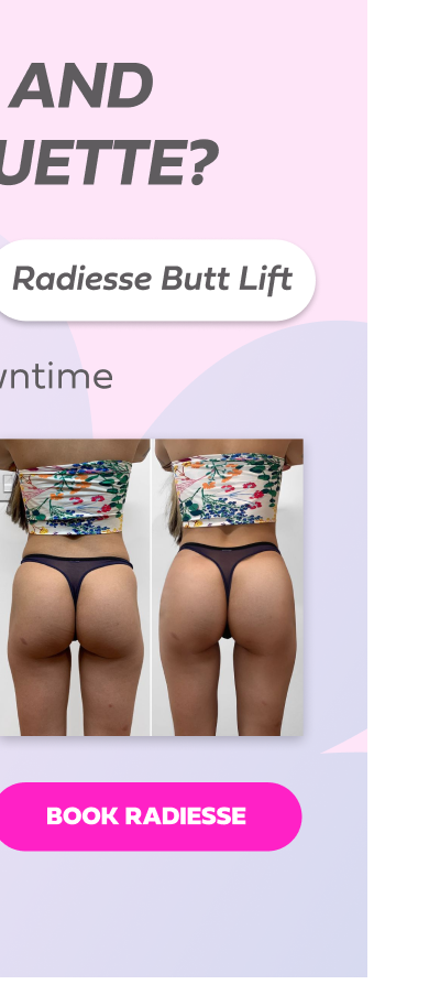RADIESSE BUTT LIFT