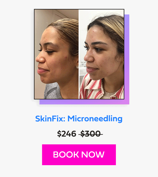 SkinFix: Microneedling
