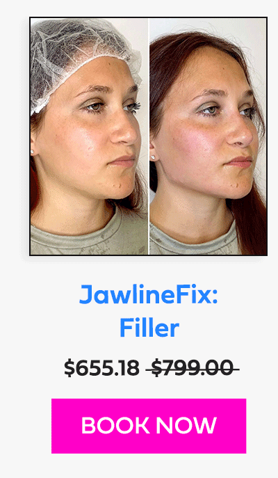 JawlineFix: Filler