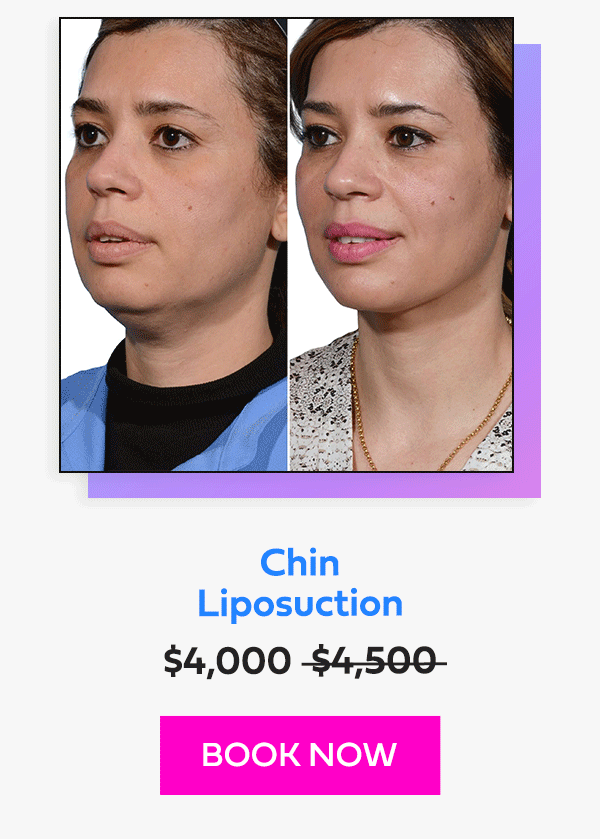Chin Liposuction