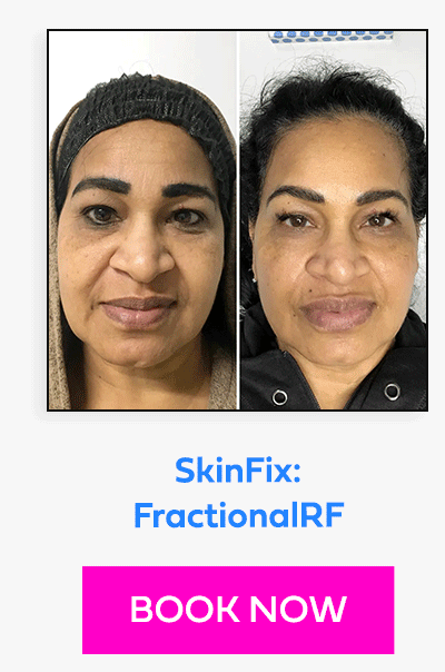 SkinFix: FractionalRF