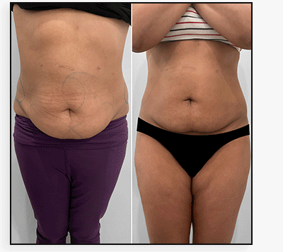 BodyFix: truSculpt iD