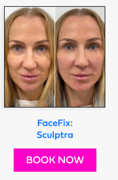 FaceFix: Sculptra