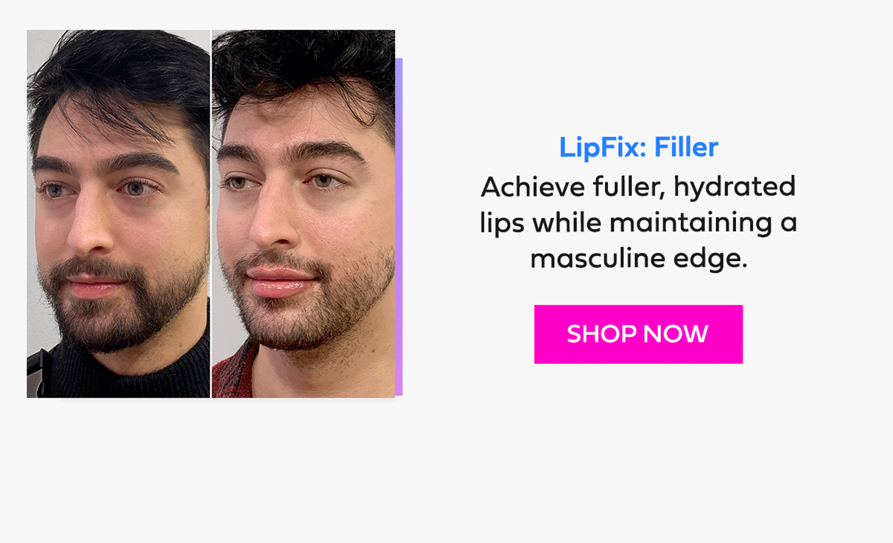 LipFix: Filler