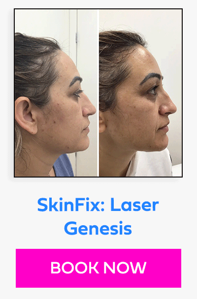 SkinFix: Laser Genesis