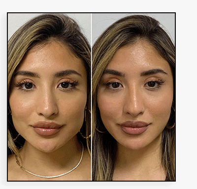 JawelineFix: Masseter Botox