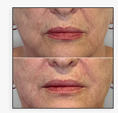 LipFix: Smoker's Line