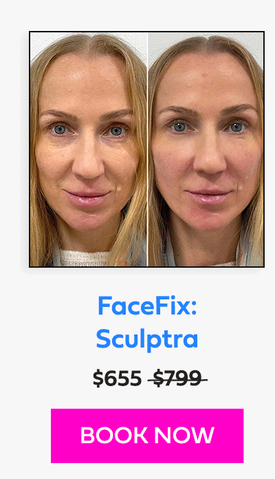 FaceFix: Sculptra