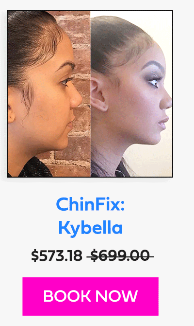 ChinFix: Kybella