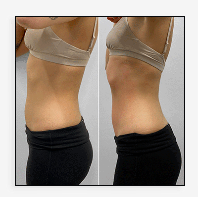 ArmFix: truSculpt iD